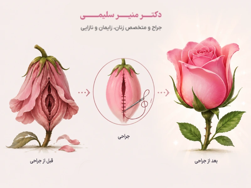 جراحی پرینورافی