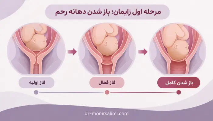 مرحله اول زایمان طبیعی و روند باز شدن دهانه رحم